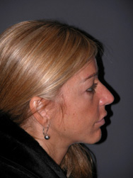 Mid Facelift - Patient 7 - Lateral Right - Before